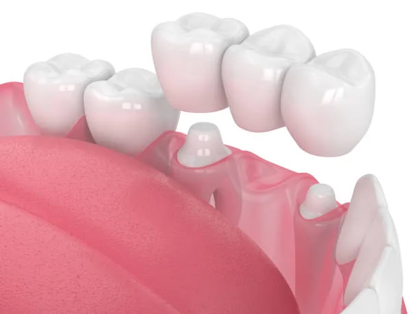 Illustration of a three-unit dental bridge fitted over two prepared teeth to replace a missing tooth