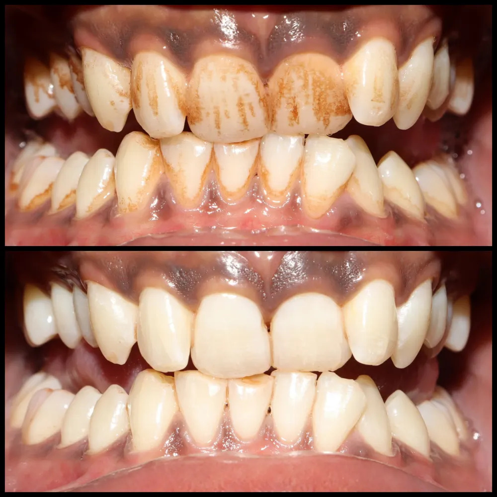 Before and after teeth cleaning: streaky tea and coffee stains removed from front teeth after polishing at GRIN Dental Care