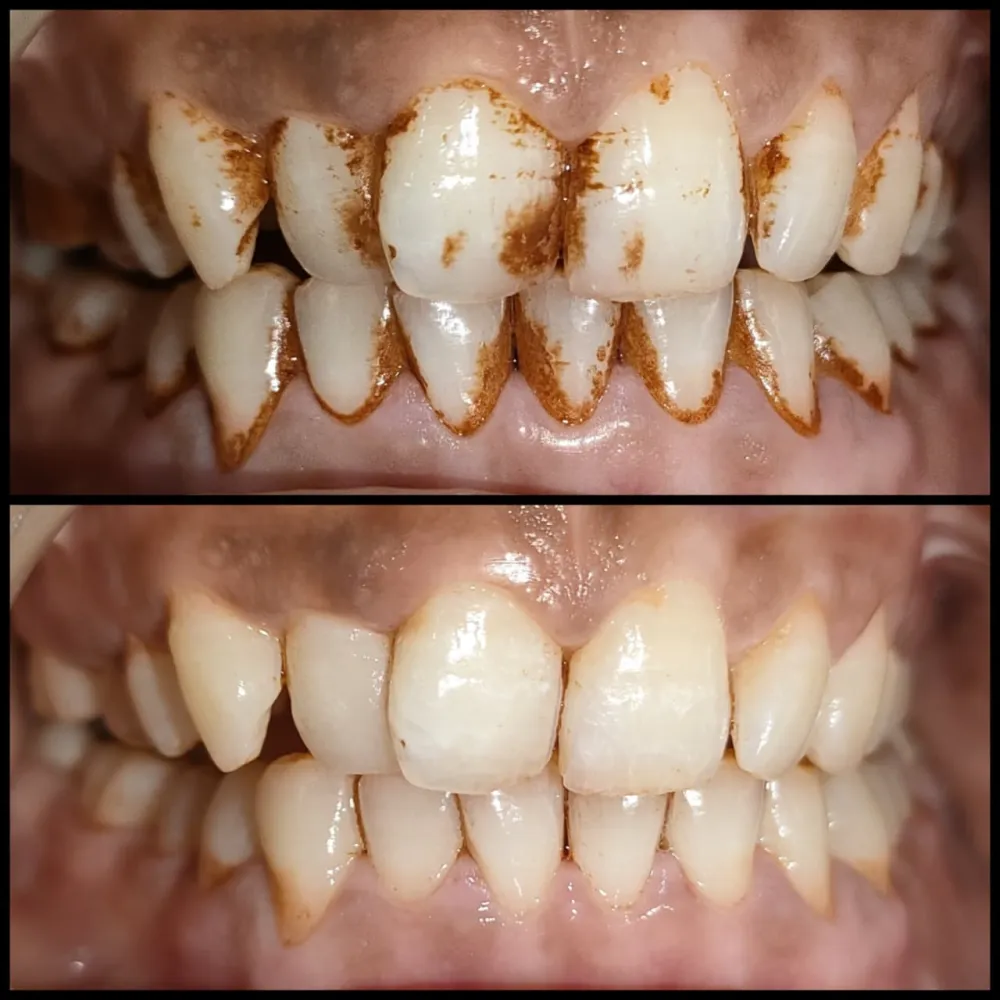 Before and after teeth cleaning: heavy brown stains and tartar removed after scaling and polishing at GRIN Dental Care